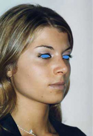Chirurgia Estetica - Rinoplastica - foto prima dopo.